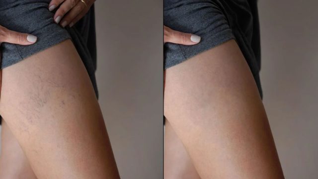 laser vasculaire dr harel lorée 2