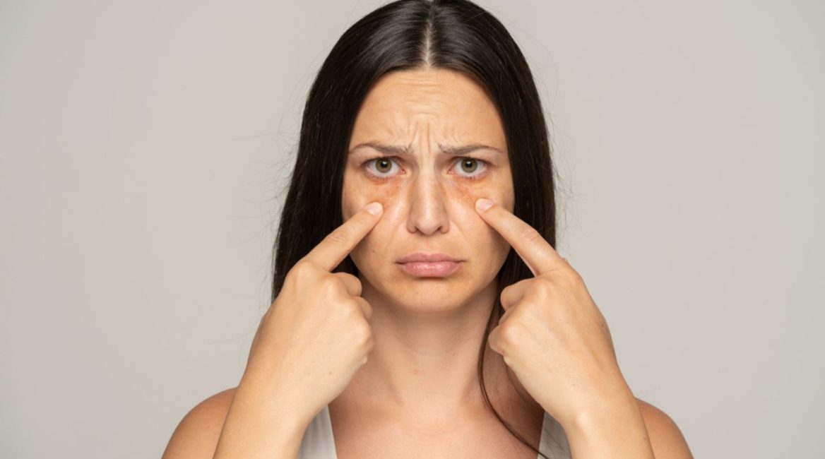 Femme montrant ses cernes sous les yeux avec une expression préoccupée