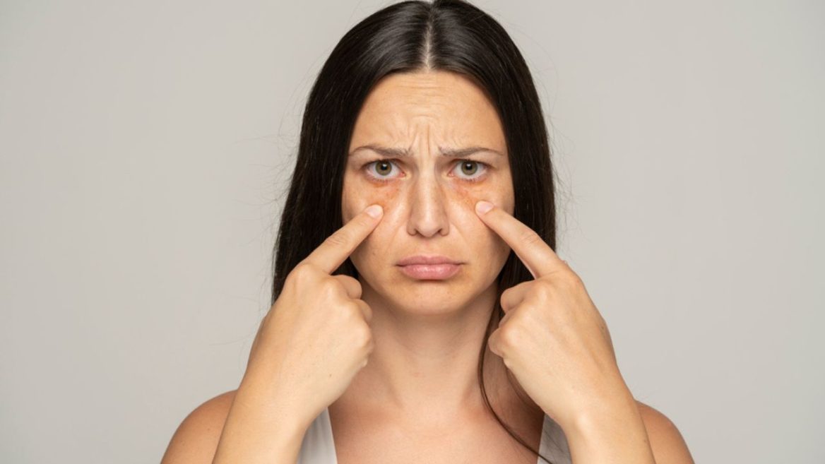 Femme montrant ses cernes sous les yeux avec une expression préoccupée
